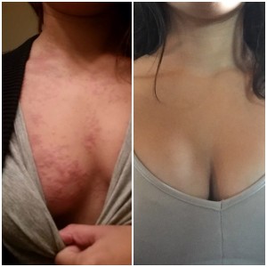 Behcet's - Skin Rash and sores on breast, chest and neck
